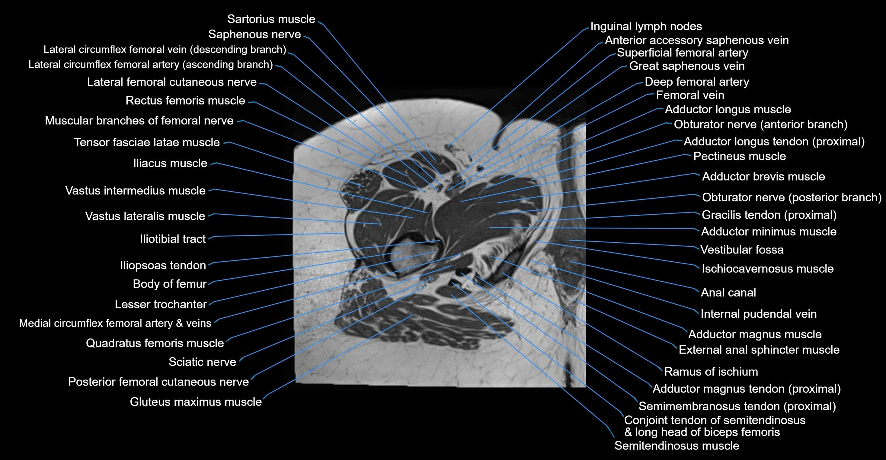 MRI hip axial cross sectional anatomy 3T 3D  radiology  anatomy image-img-00001-00069.webp